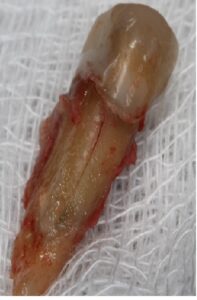 fatique fracture with crack line on tooth